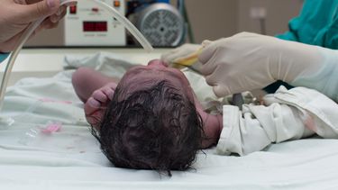 Baby geboren met ernstig zeemeerminsyndroom