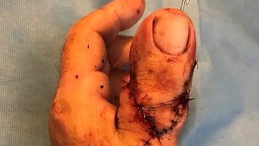 Operatie geslaagd: man vervangt duim voor grote teen