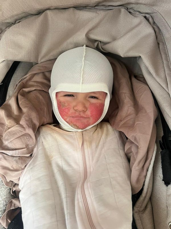 Mira (1) kan door zeldzame jeukziekte nauwelijks kind zijn: ouders hopen op redding op Bali