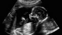 Abortus in Brazilië ook na verkrachting verboden