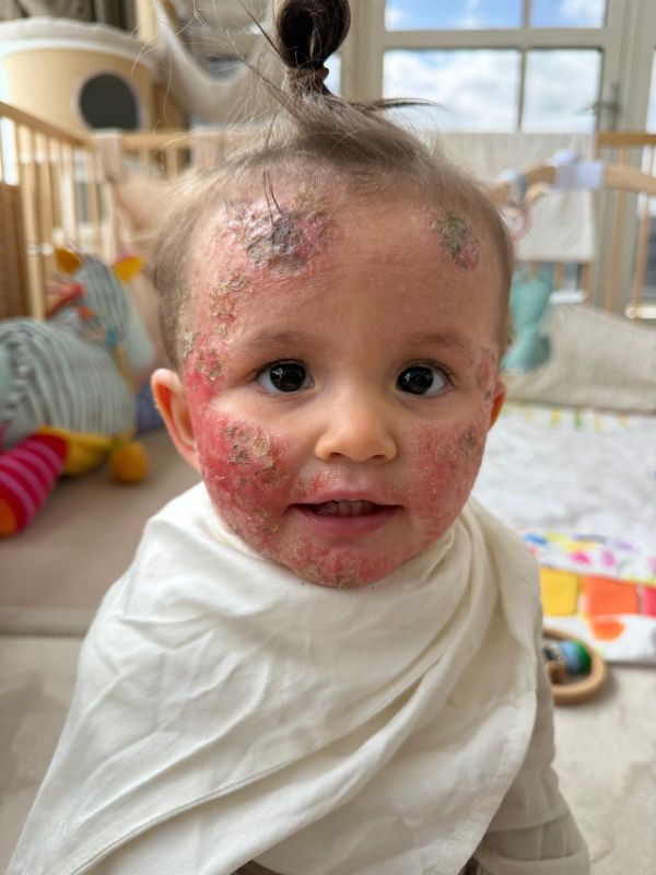 Mira (1) kan door zeldzame jeukziekte nauwelijks kind zijn: ouders hopen op redding op Bali