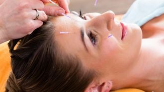 Cosmetische acupunctuur wint aan populariteit als natuurlijk alternatief voor botox en fillers. / Colourbox