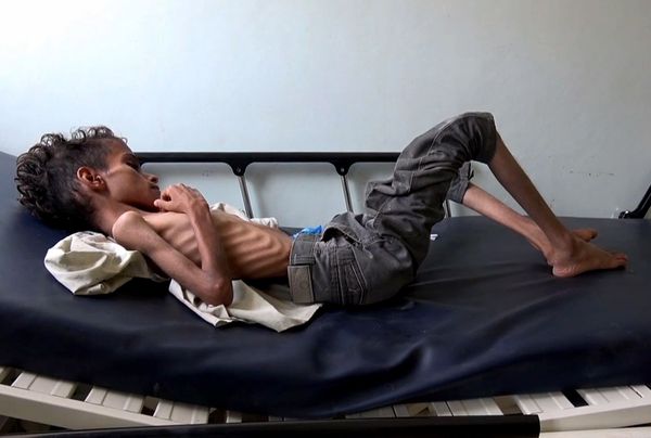 Tienduizenden kinderen overleden in Jemen