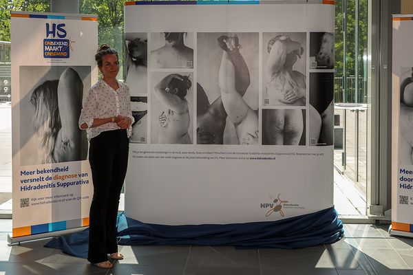 expositie meander hyperhidrosis zweten