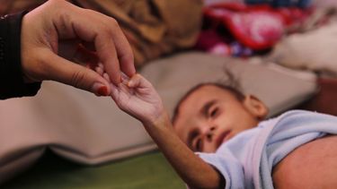 Tienduizenden kinderen overleden in Jemen
