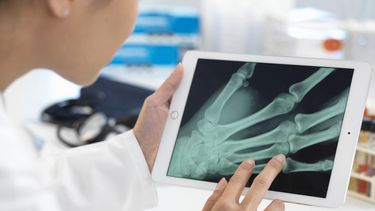 Onderzoekers ontwikkelen superlijm die botbreuk binnen drie minuten kan herstellen